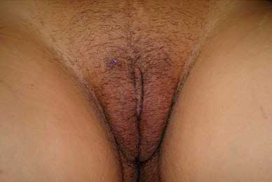 cirugía vulvo-genital láser