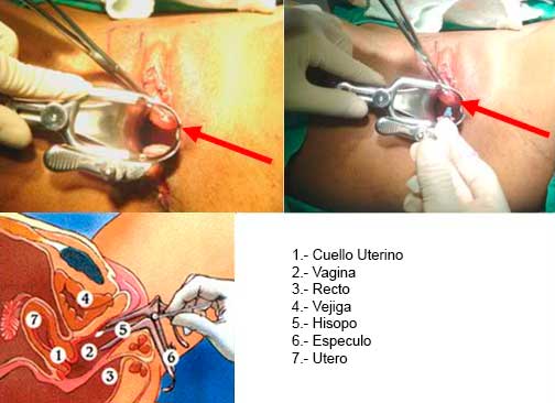 cirugía vulvo-genital láser